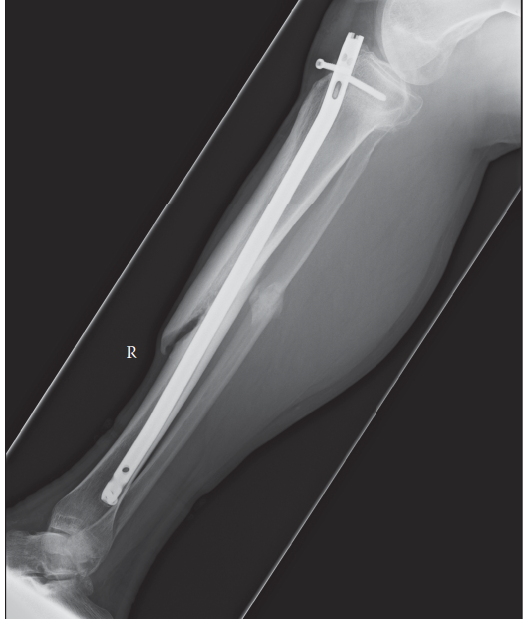 Nonunion Fractures: Signs, Diagnosis, and What to Know