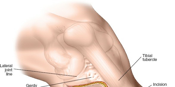 Illustration 9 for Surgical Access: Mastering the Tibia's Surface & Fibula Approaches