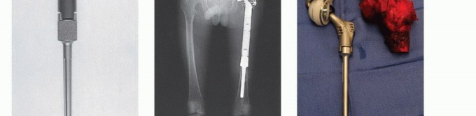 Illustration 9 for Distal Femoral Replacement: Key to Modern Limb Salvage
