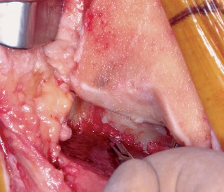 Illustration 39 for Mastering Valgus Total Knee Replacement: Techniques & Pitfalls