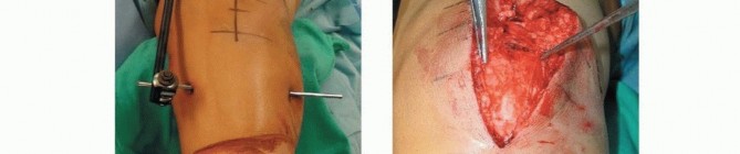 Illustration 44 for Repairing Distal Femur Fractures: Open Reduction & Internal Fixation