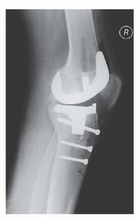 Illustration 12 for Tibial Tubercle Osteotomy: The Key to Extensile Exposure in Revision TKA