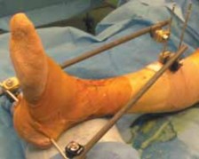 Illustration 23 for Optimizing ORIF for Tibial Plafond Fractures: A Modern Approach