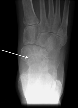 Illustration 13 for First Metatarsal Surgery: Expert Solutions for Foot & Ankle Pain
