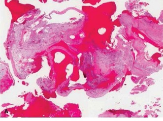 Illustration 2 for Challenging Oncology Cases: Aneurysmal Bone Cyst Diagnosis