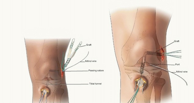 Illustration 20 for Optimizing ACL Reconstruction for Skeletally Immature Patients