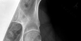 Illustration 3 for Open Hip Dislocation: How Fascia Lata Autograft Restores Stability