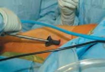 Illustration 13 for Mastering Anterior Interbody Arthrodesis with Instrumentation for Scoliosis