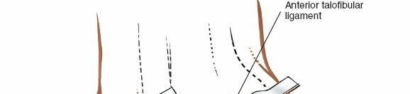 Illustration 112 for Optimized Approaches to the Dorsum of the Foot & Ankle