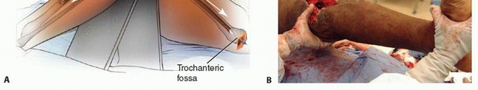 Illustration 11 for Knee Arthrodesis: A Solution for Stable Femur & Tibia Fusion