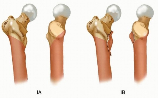 Illustration 8 for Achieve Optimal Femoral Head Fixation with Cephalomedullary Nailing