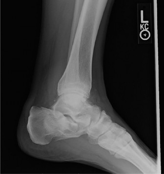 Calcaneus Fracture: Mastering Diagnosis at the Point of the Posterior