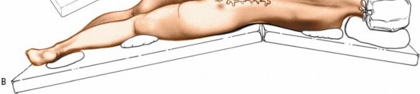 Illustration 4 for Mastering the Spine Posterior Approach: Surgical Essentials