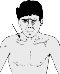 Is Your Neck Pain Thoracic Outlet Syndrome? Get Answers