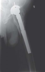 Illustration 34 for Effective Arthroplasty for Salvage of Failed Hip Fixation