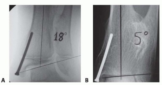 Illustration 12 for Optimizing Growth to Correct Pediatric Limb Deformities