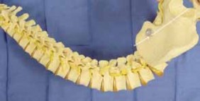 Illustration 12 for Optimizing Instrumentation for Neuromuscular Scoliosis