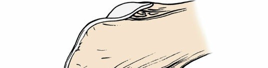 Illustration 42 for Unlocking the Medial Side of the Knee: A Surgical Anatomy Guide