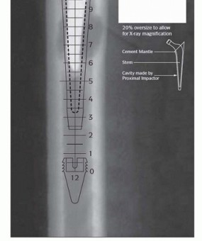 Illustration 6 for Exeter Hip Unit: Mastering Impaction Allografting for Femoral Bone Loss