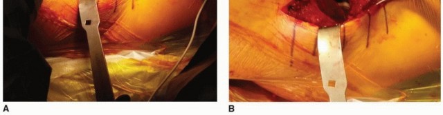 Illustration 5 for The Tapered Stem: Your Guide to Durable Cementless Hip Fixation