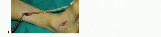 Illustration 29 for Foot Drop Surgery: How a Pin or Drill Elevates Tendon Transfer