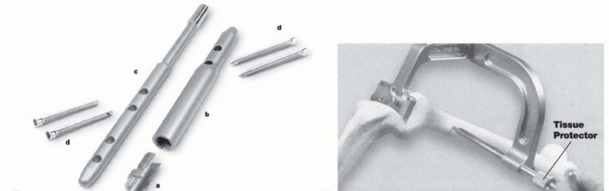 Illustration 5 for Knee Arthrodesis: A Solution for Stable Femur & Tibia Fusion