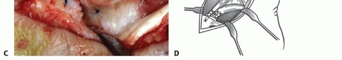 Illustration 35 for Medial Ankle Instability: Find Relief with Reconstruction
