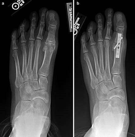 Illustration 57 for First Metatarsal Surgery: Expert Solutions for Foot & Ankle Pain