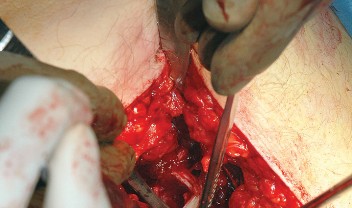 Illustration 40 for Unlock the Figure Posterior Approach to the Hip