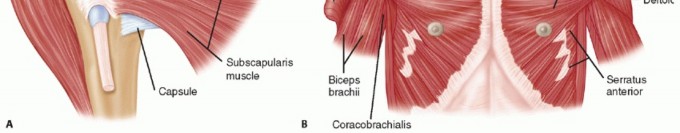 Illustration 2 for Irreparable Subscapularis Tears? Explore Pectoralis Major Transfer.