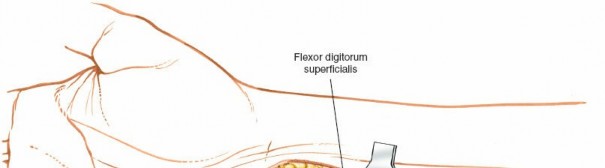 Illustration 45 for Volar Approach: Optimal Exposure for the Volar aspect of the Distal Radius