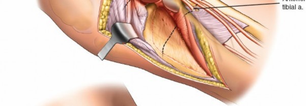 Illustration 48 for Surgical Access: Mastering the Tibia's Surface & Fibula Approaches