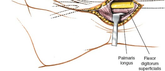 Illustration 18 for Volar Approach: Optimal Exposure for the Volar aspect of the Distal Radius