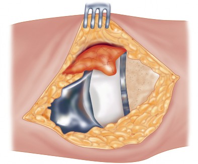 Illustration 40 for Precision Soft Tissue Balancing in Revision: Avoid TKA Pitfalls