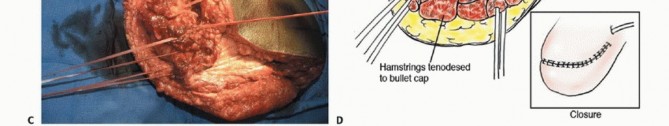 Illustration 31 for Mastering Hip Disarticulation: Through the Hip Joint Capsule