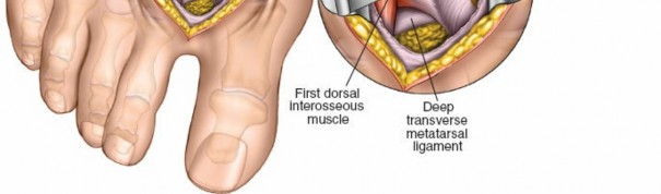 Illustration 209 for Optimized Approaches to the Dorsum of the Foot & Ankle