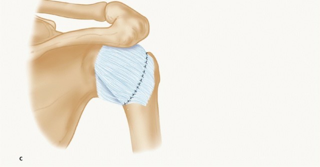 Illustration 18 for Mastering the Treatment of Recurrent Posterior Shoulder Instability