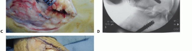 Illustration 9 for Lateral Ankle Repair: Maximize Stability with Interference Screw Fixation