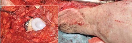 Illustration 80 for Optimizing Infected THA: The One Staged Approach Explained