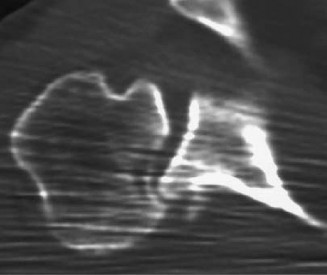 Illustration 3 for Pinpoint Posterior GH Instability: Diagnosis & Causes