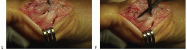 Illustration 28 for Mastering the Biplanar Distal Chevron for Effective Bunion Surgery