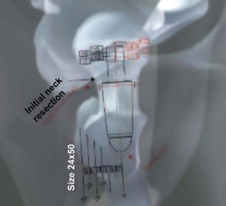 Illustration 7 for The Silent Hip: Achieving a Truly Silent, Pain-Free Joint
