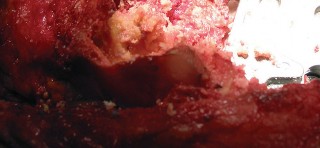 Illustration 5 for Understand Augments: The Role of Metal Augments in Arthroplasty