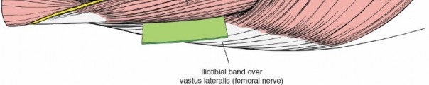 Illustration 38 for Optimal Femoral Approaches: Mastering the Lateral Intermuscular Septum