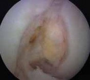 Illustration 8 for Successful Ligament Repair Revision: Fixing Failed ACLs