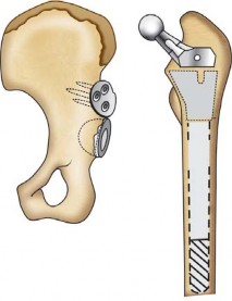 Illustration 128 for Successful Total Hip Replacement in Developmental Dysplasia