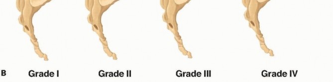 Illustration 3 for Mastering High-Grade Spondylolisthesis: Posterolateral and Interbody Fusion