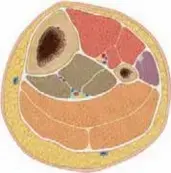 كسور قصبة الساق لدى الأطفال: دليل شامل للآباء نحو التعافي الآمن