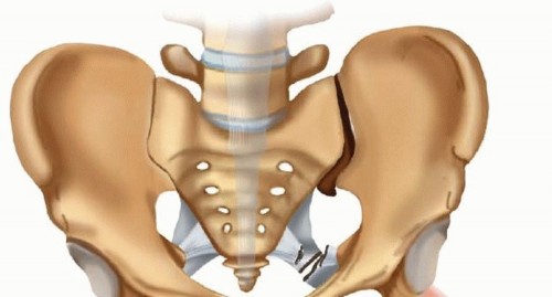 Illustration 6 for Achieve Stable Fixation of the Symphysis: Open Reduction