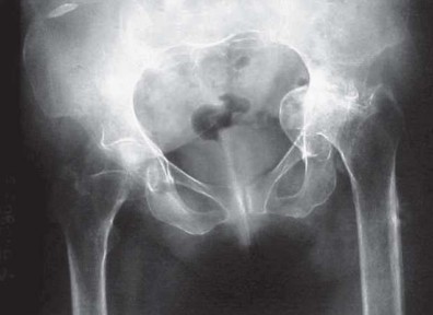 Illustration 5 for Total Hip Replacement for Protrusio: Restore Your Hip Function